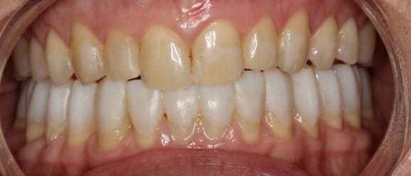 How TMJ Treatment Changed A Life