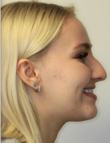 Finding TMJ Relief with Neuromuscular Dentistry