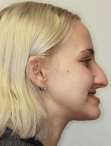 Finding TMJ Relief with Neuromuscular Dentistry