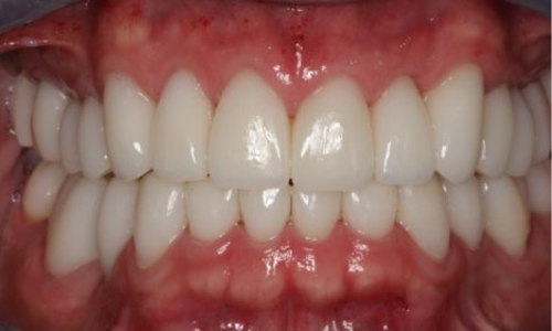 Broken, Worn Teeth Transformation