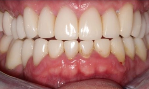 Broken, Worn Teeth Transformation