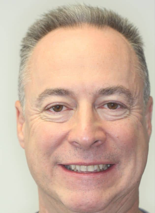 Broken, Worn Teeth Transformation