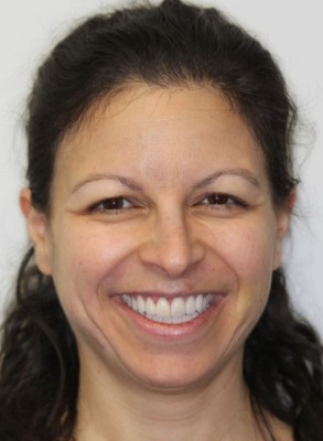 transformative bite for female TMJ patient